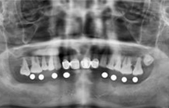下半口多颗牙种植修复