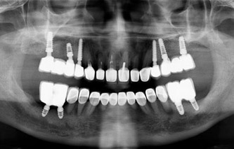 双侧多颗牙种植修复